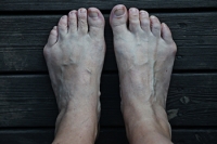Tailor's Bunion Symptoms